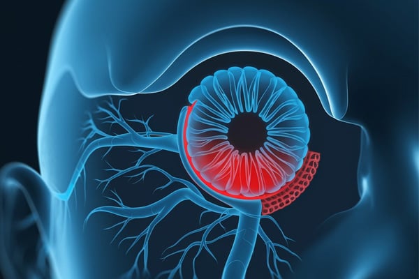 Animación del ojo y el nervio óptico en la que se muestran las zonas rojas afectadas por la NAION de origen farmacológico